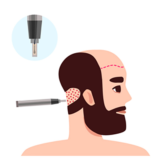 Fue Extraction