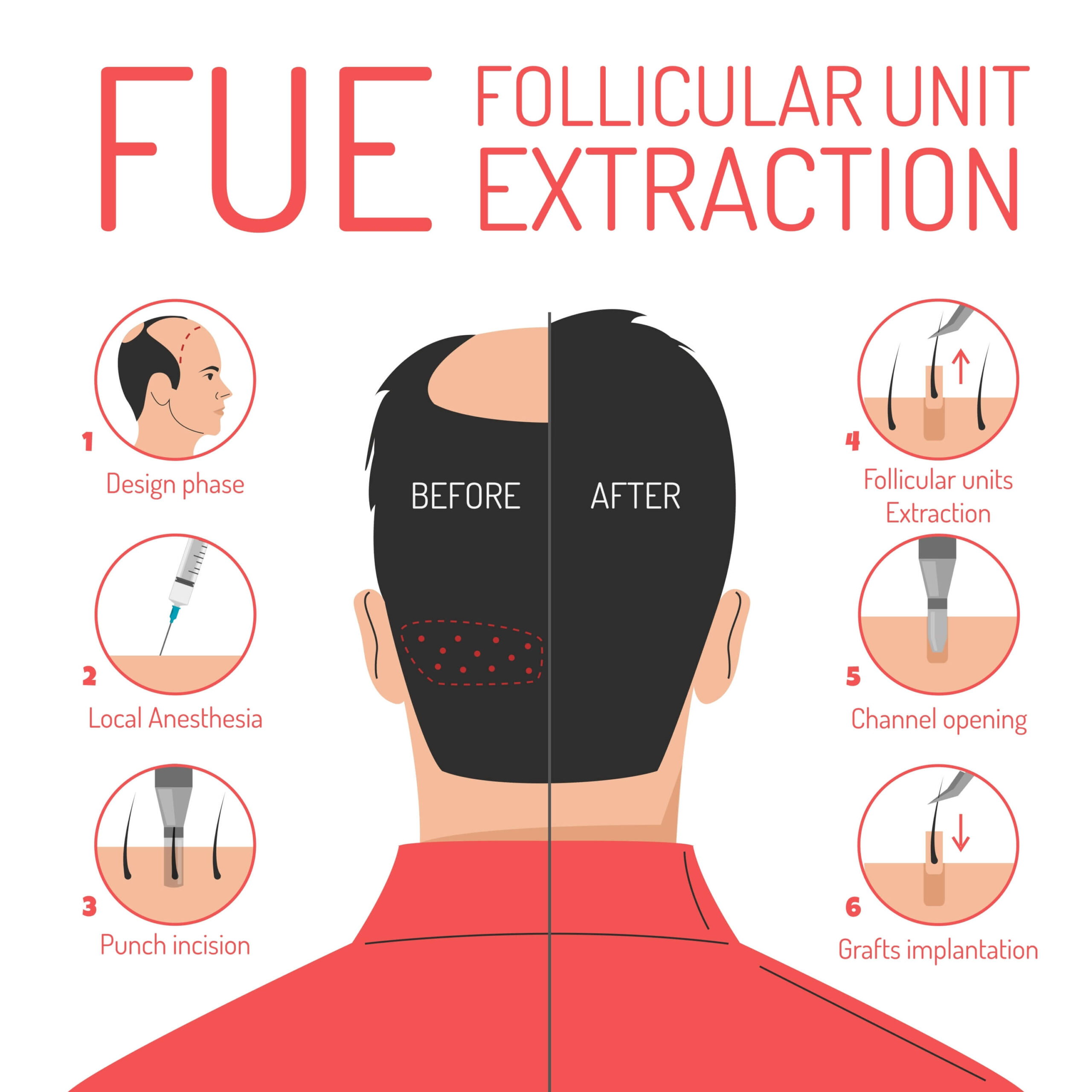 Fue Hair Transplant Does Hair Transplant Work