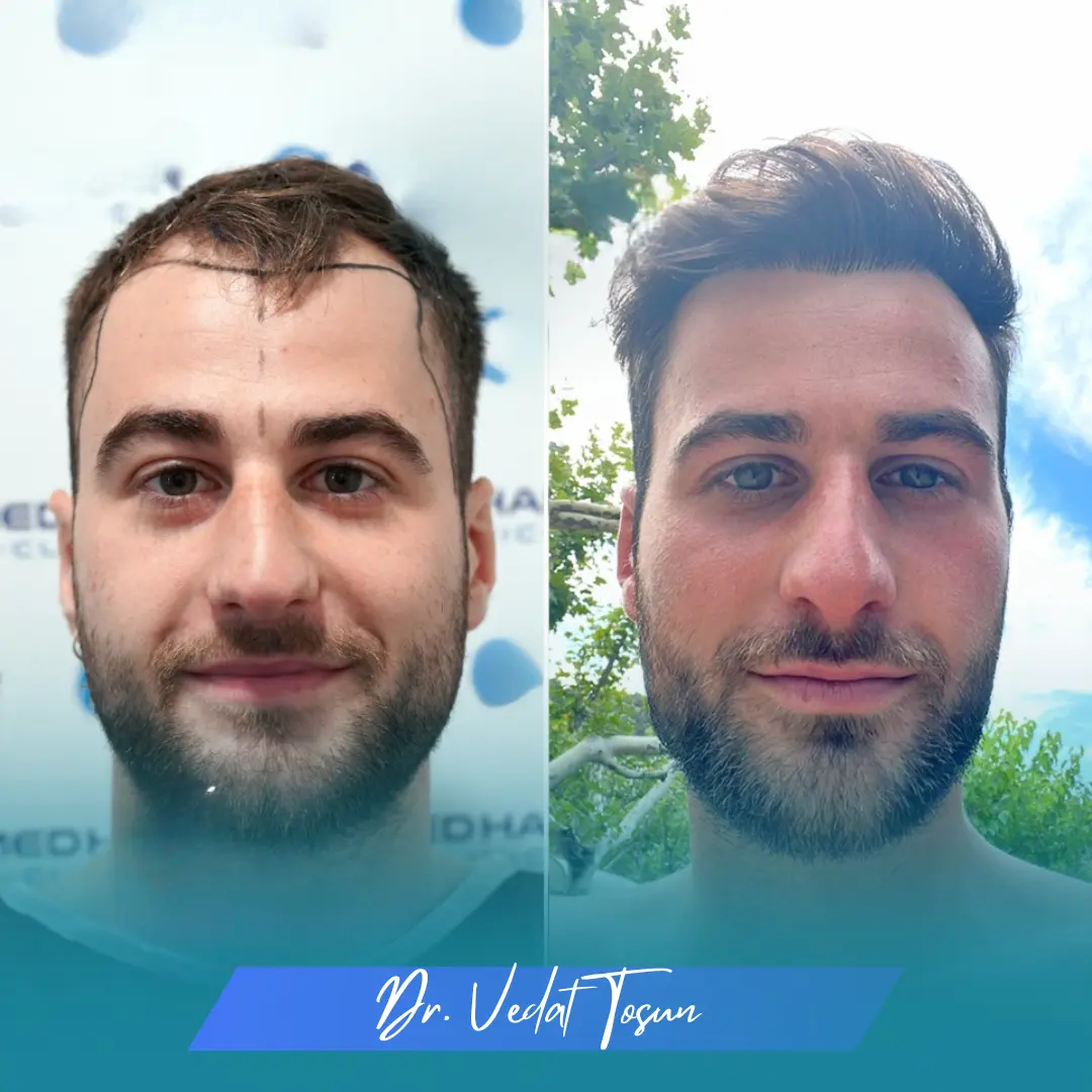 Vedat Before and After Images Completed