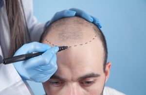 Hair transplant right for you
