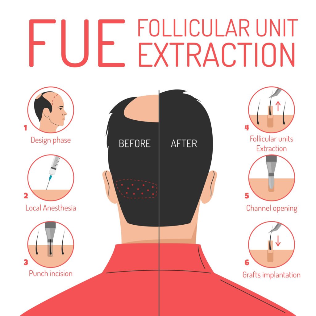 Fue Hair Transplant Does Hair Transplant Work