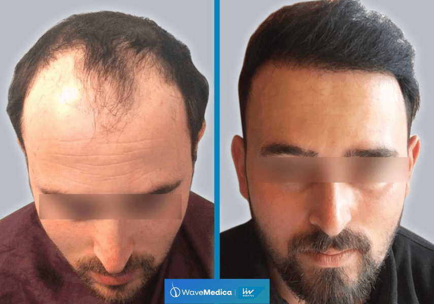 Trusted Hair Transplant Clinic in Istanbul, Turkey | Wavemedica